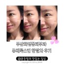 부산화명동피부과 쥬베룩스킨 한달차 만족 후기