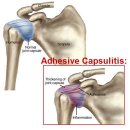 도수치료 - 회전근개 증후군 (rotator cuff syndrome)1 이미지