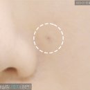 로담 | 여드름 파인 흉터 피지 압출 노원역 피부과 새살침 치료 후기(로담한의원 노원점)