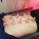 황제쑥뜸 이미지