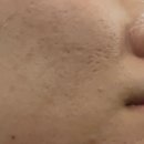 우태하피부과의원 동대문점 | 오가나셀 피부과의원 동대문점 여드름 흉터 치료 1차 후기