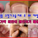 내성발톱 교정기.수술.치료 후 왜 재발할까? (부제: 내향성발톱, 조갑박리증 근본 치료) 이미지