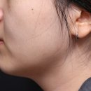 시티피부과의원 | 디지털미디어시티역 피부과 | 세르프 리프팅 2주차 솔직 후기