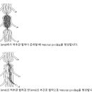 척추관협착증에 의한 신경인성 파행의 기전(neurogenic claudication) 이미지