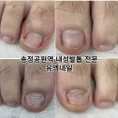 송정공원역 | 송정공원역 내성발톱 전문 유엠네일
