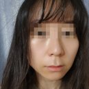 창원 리프팅, 팔자주름 관리 잘하는곳: 상남동 미시안뷰티뱅크