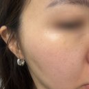 월곡한의원 | 서울 편평사마귀 무제한 성지 편평사마귀 제거 co2레이저 내돈내산 후기