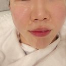 별다방가든 | 선릉피부과 세르프 이중턱 윤곽 관리 600샷 효과 보고 별다방 커피도 받아가세요 /서이추