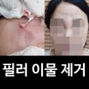 뷰티스톤의원 - 수원시 영통구 법조로 25 | 코필러 부작용 후기 이물제거와 부작용 전문