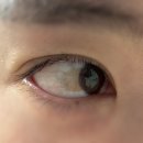 나만 빼고 다 한다는 ETF | 부산서면 결막모반 제거 후기(눈 흰자 점 빼기)