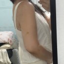 새솔해피라인의원 | 수원 지방분해주사 후기 | 뼈 팔 도전기 3회차💪🏻