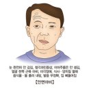 안면 마비[Facial palsy뇌신경정신질환] 이미지