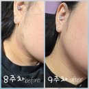 이플러스학원 | [내돈내산] 홈모드 써마 리프트 후기 (9주차)