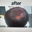 철산탈모 닥터포헤어광명점 탈모관리 후기