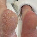 레푸스청라점 | 청라발각질 깔끔하게 잘 하는 레푸스인천청라점