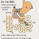 당뇨, 수술로 고치는 시대 열리나 이미지