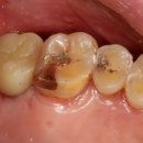 구로중앙치과의원 | 서울 구로구치과 치성 상악동염, 임플란트 가능할까요?