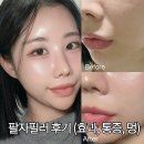 멍스타일 | 강남피부과 팔자필러 후기 (효과, 통증, 멍)