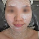 리샘한의원 부천점 무제한 편평사마귀 제거 후기 경과기록