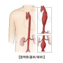 대동맥류(Aortic aneurysm) 이미지