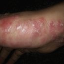 베데스타한의원 | 엔스틸룸폼 쓰고 건선 일주일만에 거의 다 나았습니다.