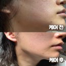리앤스톤 | 트러블 피부 문제성 피부 관리 내포 리앤미에스테틱 피부 맞춤 케어 후기