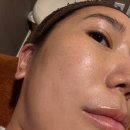기미 색소참착 고민 여의도피부과 코레지토닝 nmn 후기