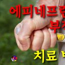 사암침, 사암침법 - 에피네프린 (아드레날린) 부작용 치료 방법 - 비과학적 양의학 130 이미지