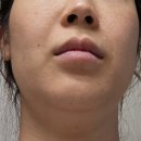 류라인의원 | 신사 레지움피부과 덴서티 리프팅 찐후기 (클래식팁)