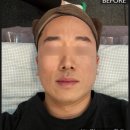 우미K뷰티 | [목포 피부관리 벨라미] [하이푸 리프팅] 남자 피부관리 강력추천
