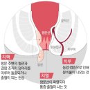 치질에 대해 알아보자 이미지