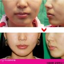 미고성형외과 | 미고성형외과 매직사각턱수술 후기