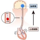 뇌경색의 큰 원인「심방세동」 발견하기 어려운 이유는？ 이미지