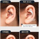 귀건강(이혈테라피) 이미지