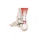 대송한의원 | 축구에서의 '아킬레스건파열'에서 수술, 비수술?