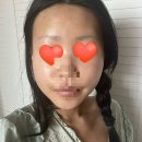 뉴스코화장품 | 💉 풀페이스 지방이식_1~4일차 후기