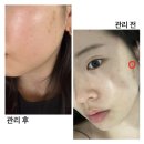 인천계양구효성동 <여드름, 흉터, 나노테라피> 피부관리 투모로우스킨엔바디 후기