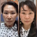 🌿 슈링크유니버스울트라600샷 리얼후기 대구제이린의원 방문기, 효과·통증·붓기 솔직하게 공유