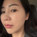 건강소망약국 | 압구정성형외과 스킨부스터 엘라비에 리투오 후기 모공 리프팅 통증 효과