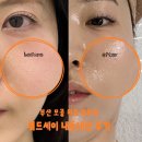 세이인테리어 | 부산피부과 모공치료 쿼드세이 고주파시술 내돈내산 후기 및 부작용