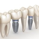 하나치과기공소 이미지