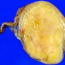 복막하 장벽내 가스, Pneumatosis intestinalisㅡ위 이미지