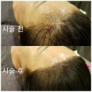 필헤어라인 이미지