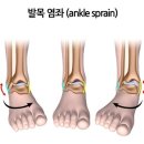 발목 삐었을 때, 한방처방 종합 정리 이미지