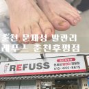 문제성발톱, 발톱무좀관리 다락방 | 레푸스 춘천후평점에서 문제성 발관리, 무좀발톱 관리 솔직후기
