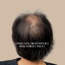 꾸기비어 | 울산탈모관리 대머리 후기