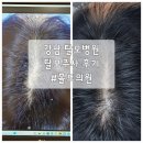 화한의원 | 탈모병원 홀드의원 방문후기, 자꾸 빠지는 머리카락이 고민일때 추천
