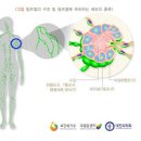 호지킨림프종과 악성림프종의 차이와 증상 이미지