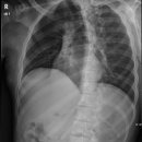 Rib PA Oblique 이미지