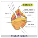 무수혈을 통한 인공관절수술 이미지